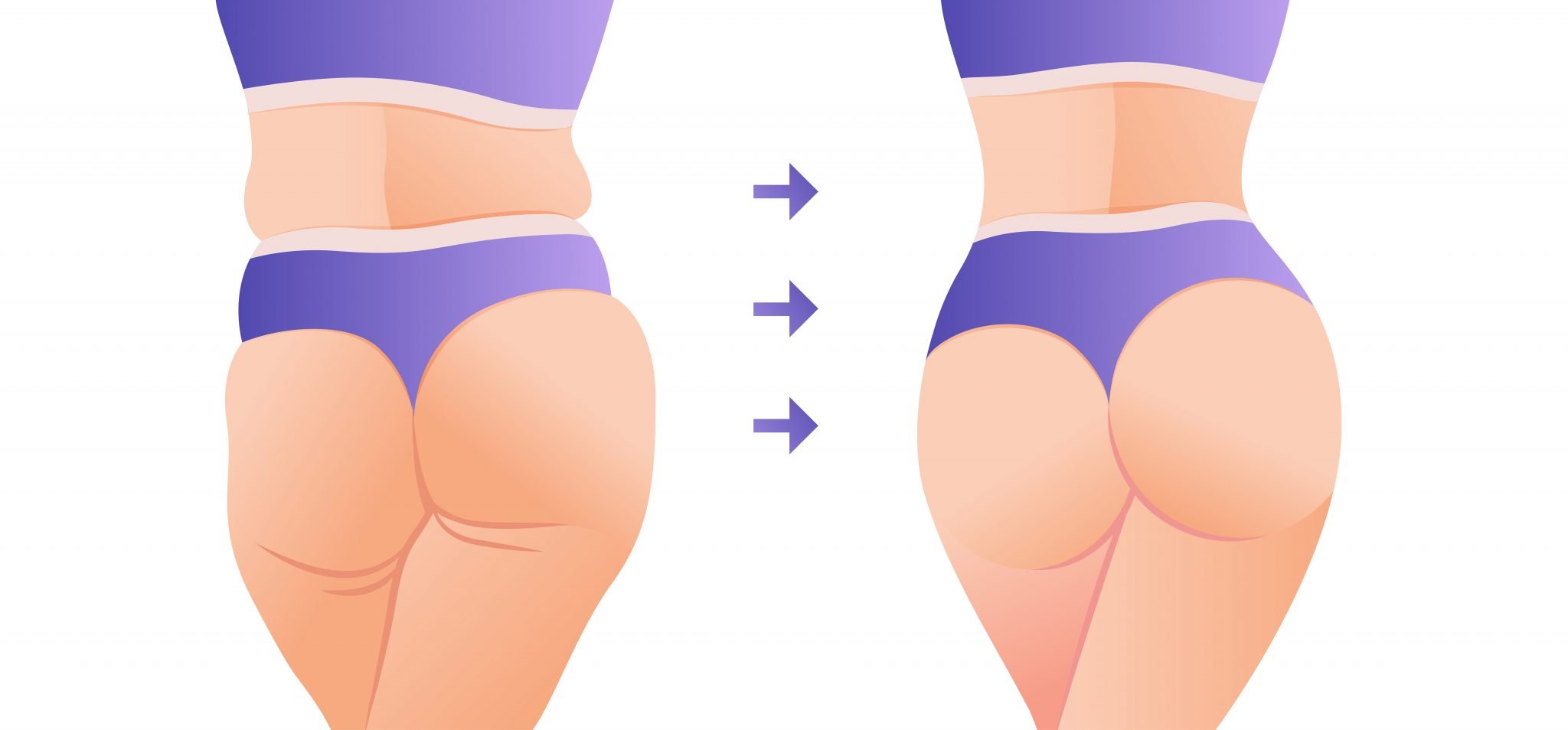Will BBL Make Your Cellulite Worse?