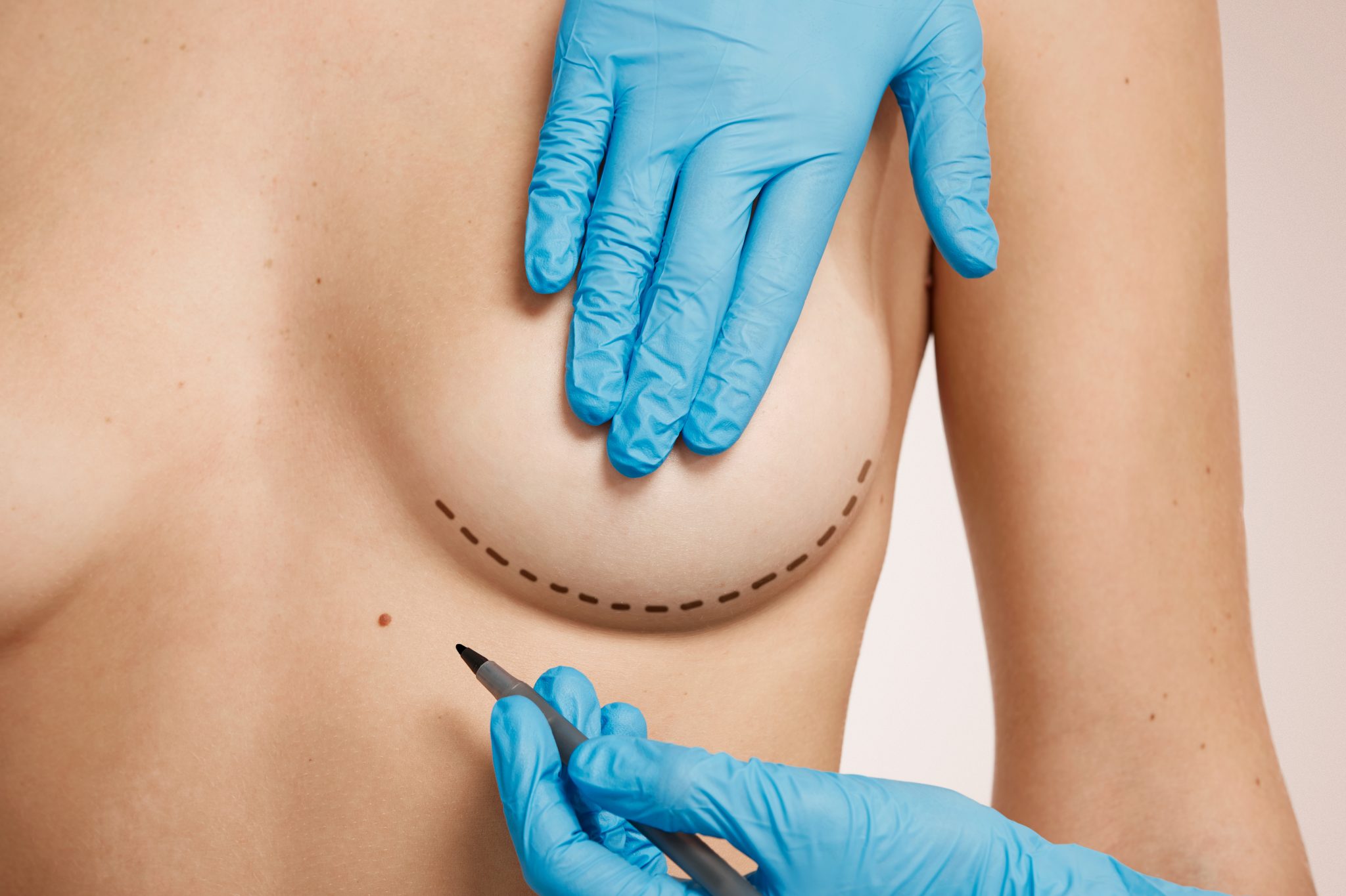 Self-Fat Injection or Implant For Breast Augmentation?